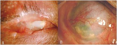 Allogeneic Cultivated Limbal Epithelial Sheet Transplantation in Reconstruction of Conjunctival Sac After Chemical and Thermal Burns